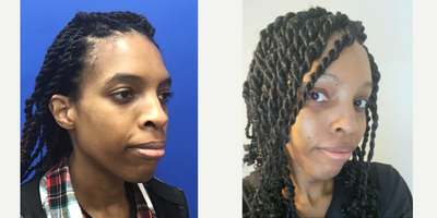 Patient treated with African American Rhinoplasty - Septorhinoplasty (Closed) with Cartilage Grafts - 25 to 34 year-old female patient is 8 months post-op from Facial Feminization surgery. Her procedures included: Forehead Lift, Hairline Lowering, Orbital Bony Contouring; Chin Implant (Central) with Chin Reduction and Contour; Cheek Implants (Small); Thyroid Cartilage Shave and Voice Feminization; Fascia to Upper Lip; Internal Lip Lift and Septorhinoplasty (Closed) with Cartilage Grafts.