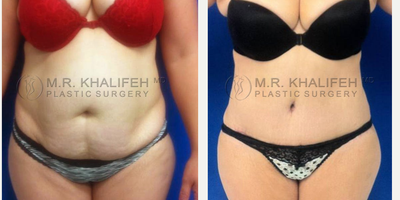 Woman treated with Mommy Makeover - Woman treated with Mommy Makeover