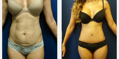 Woman treated with Mommy Makeover - Woman treated with Mommy Makeover