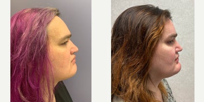 25-34 year old woman treated with Forehead Reduction, Brow Bone Reduction, Brow Lift, Septoplasty, Cheek Augmentation, Genioplas - This young lady underwent forehead feminization, blepharoplasty, septorhinoplasty, cheek augmentation, and genioplasty.