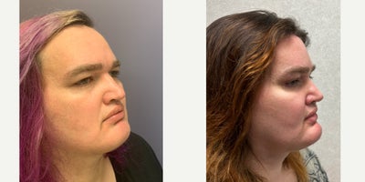25-34 year old woman treated with Forehead Reduction, Brow Bone Reduction, Brow Lift, Septoplasty, Cheek Augmentation, Genioplas - This young lady underwent forehead feminization, blepharoplasty, septorhinoplasty, cheek augmentation, and genioplasty.