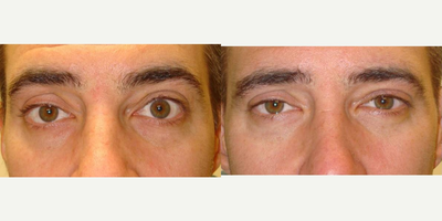 28 year old man treated with Eyelid Retraction Repair - 28 year old male, who underwent left upper eyelid retraction surgery.