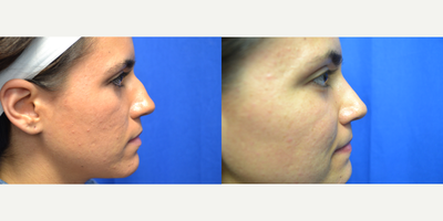 25-34 year old woman treated with Rhinoplasty - 25 year old female had closed rhinoplasty to improve nasal hump.