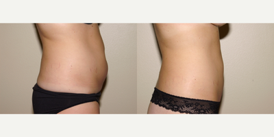 25-34 year old woman treated with Liposuction - Tumescent liposuction of the abdomen