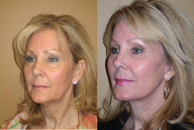 facelift - facelift