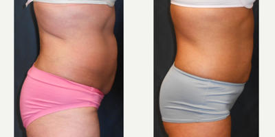 45-54 year old woman treated with SculpSure - Before & After ONLY 1 Treatment of SculpSure on her Abs & Flanks! More results to come!