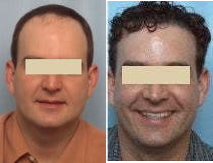 Man treated with Hair Transplant - Man treated with Hair Transplant withFleming/Mayer flap