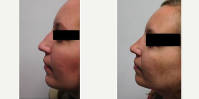 Woman treated with Rhinoplasty - This young lady wanted the hump on her nose reduced and her tip slightly rotated up. We were able to accomplish this and yet still enable her to look natural.