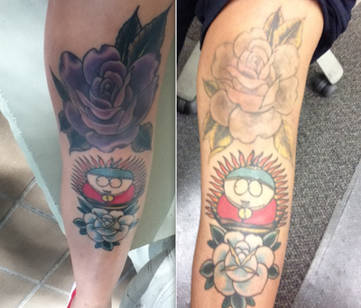 ... Tattoo Removal on Knee Tattoo - MIAMI, FL - PicoSure review - RealSelf