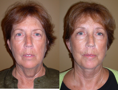 facelift - 
	facelift