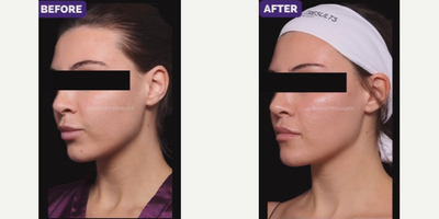 25-34 year old woman treated with Buccal Fat Removal - Buccal fat pad removal is a procedure that permanently reduces the size of your cheeks.The procedure can be done under local numbing with minimal downtime.