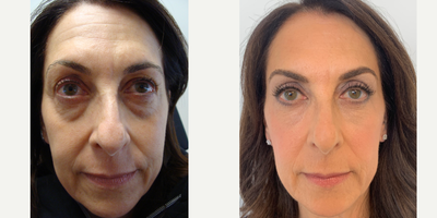 55-64 year old woman treated with Brow Lift - This patient underwent a left brow lift + blepharoplasty + removal of under eye fat prolapse and laser resurfacing
