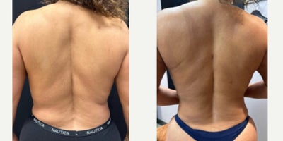 35-44 year old woman treated with Vaser Liposuction, Laser Liposuction - Women treated with Power Assisted Liposuction to the Upper, lower Back and Flanks.