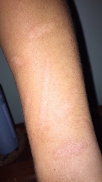 i-have-these-old-burn-scars-on-my-arm-and-i-want-to-know-how-to-get-rid