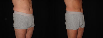 52 year Old Male Treated with Liposonix - 
	Male patient's waistline reduced by 11 cm. This patient received Liposonix as well as leading a healthy lifestyle.