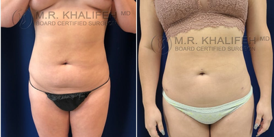 25-34 year old woman treated with Smart Lipo - This patient underwent awake liposuction of the abdomen, lower back flanks, with small volume (about 500cc) fat grafting to each buttock region, results are shown at the three months mark. Incisions, still bright red, are well demonstrated, and are expected to fade to a white imperceptible color of the next 6 months.