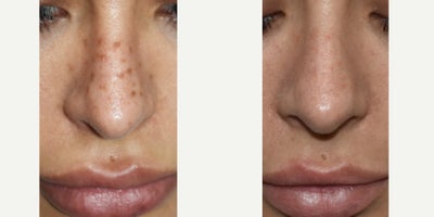 Permanent Makeup Removal before and after photos Los Angeles - Permanent makeup can look great...until it doesn't. The challenge is that many inks used for permanent makeup oxidize (change color) over time, leading to an unnatural appearance that many of our patients want to reverse. If you've got questions about bad permanent makeup, give us a call today.
