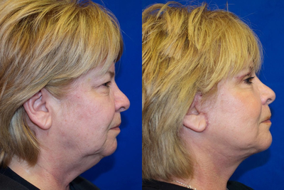 Woman over 60 years old treated with Facelift - Woman over 60 years old treated with Facelift