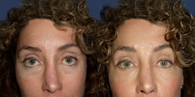 45-54 year old woman treated with Eyelid Surgery - eyelid lift