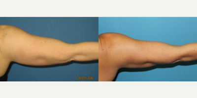 Woman treated with Vaser Liposuction - Liposuction - Arms / Axillary Before & After