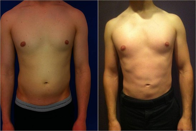 Laser Liposuction -
Laser Liposuction