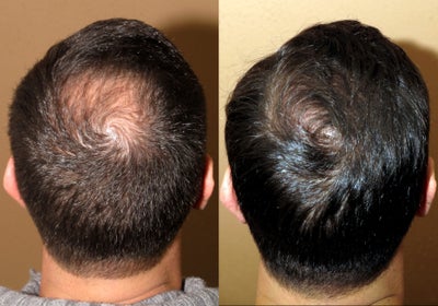 FUE hair transplantation - crown restoration no linear scars - This young man has been agonizing about crown hair loss - we were able to restore his coverage in a natural way using FUE techniques without creating debilitating linear scar that is typical for a traditional strip hair transplant