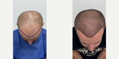 25-34 year old man treated with DHI Hair Transplant - This case presents the scalp condition 1 month after a DHI hair transplant performed at FullFace Clinic.At this stage, the transplanted area is fully healed, and early regrowth is beginning to appear. Some shedding of transplanted hairs (shock loss) may still be present, which is a normal and expected part of the hair growth cycle after transplantation. The skin condition is calm, without signs of inflammation or scarring.The DHI (Direct Hair Implantation) technique was used, allowing precise placement of grafts with full control over angle, direction, and depth. This precision is especially important for the frontal hairline, where natural orientation determines the final aesthetic outcome.At 1 month post-op, the hairline design and graft distribution can already be clearly assessed. The implanted area shows even spacing and a natural transition between native and transplanted hair. The donor area demonstrates good healing with no visible overharvesting.This stage represents an early phase of the regeneration process. Visible density and final cosmetic results typically develop gradually between months 6 and 12, as the transplanted follicles enter their active growth phase.