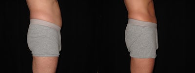 52 Year Old Male Treated with Liposonix - Patient received Liposonix on the waistline. His waistline was reduced by 11 cm with Liposonix and healthy lifestyle.