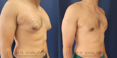Man treated with Gynecomastia Surgery - Man treated with Gynecomastia Surgery