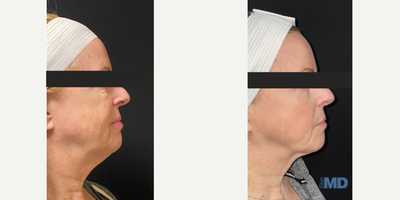45-54 year old woman treated with FaceTite - This lovely patient saw tremendous results with her FaceTite procedure. She is continuing to treat area with Morpheus RF over the next few months, as well to continue improvement on her targeted jowls/neck area.