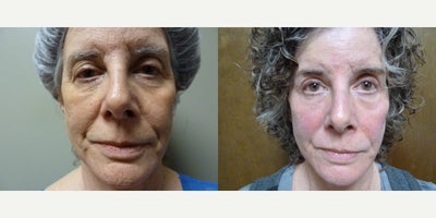 55-64 year old woman treated with Active FX - Active FX Co2 laser resurfacing
