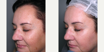 45-54 year old woman treated with IPL - This patient was concerned with the sun damage and the uneven appearance of her skin. She received 1 IPL treatment.