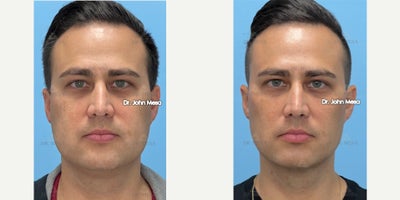 35-44 year old man treated with Buccal Fat Removal, Extended Chin Liposuction, NeckTite, FaceTite, Morpheus8 - 35-44 year old man treated with Buccal Fat Removal, Extended Chin Liposuction, NeckTite, FaceTite, Morpheus8