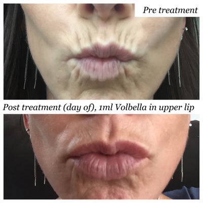 lip lines volbella juvederm realself