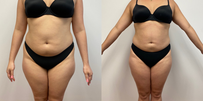25-34 year old woman treated with Liposuction - 2.5 months after liposuction of abdomen flanks and thighs