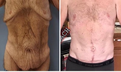 35-44 year old man treated with Male Tummy Tuck - This patient had circumferential abdominoplasty, hernia repair and breast extended reduction/lift