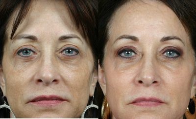 Pearl -
64yr old female unhappy with uneven pigmentation and brown spots on face. She had 1 PEARL treatment.