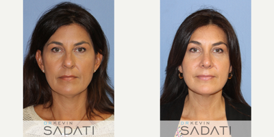 Septo-Rhinoplasty on 50 Yr Old Orange County Female - Septo-Rhinoplasty on 50 Yr Old Orange County Female