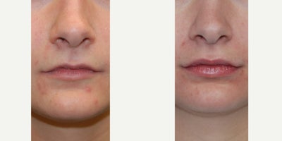 18-24 year old woman treated with Silikon 1000 - Our beautiful patient is seen before, and 5 years following two treatments with microdroplet Silikon-1000, for natural looking and permanent lip augmentation. She came to see us as a teenager, when she was concerned about the overall small appearance of her lips. She had she received two treatments at monthly intervals, and we haven't seen her until today, 5 years later. In the after photos, you can see natural looking lip augmentation, that is subtle, and in our opinion, more attractive than temporary gel fillers, like hyaluronic acid. Additionally, unlike ha, microdroplet Silikon-1000 is never associated with necrosis, embolus, infection, blindness, stroke, or biofilm. In our experience over 26 years, microdroplet Silikon-1000 injections is the safest filler, and we have also been able to deliver completely natural looking results that last a lifetime.