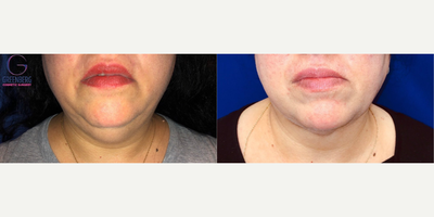 Woman treated with Chin Liposuction - Woman treated with Chin Liposuction to get rid of fat under her chin and restore facial contour for a more balanced proportion