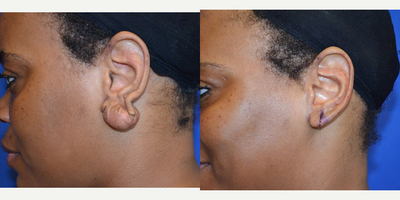25-34 year old woman treated with Ear Lobe Surgery - This woman came in wanting to improve the appearance of her ears and specifically remove the keloids. After having a consult with Dr. Ho, the patient elected to have an earlobe repair procedure.