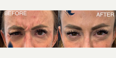 Woman treated with Botox - Woman treated with Botox