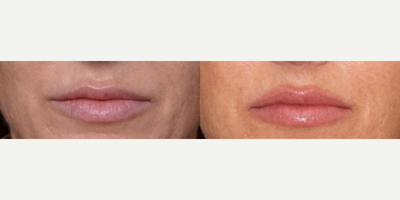 Woman treated with Restylane Kysse, Lip Fillers - Restylane Kysse is our newest lip filler that will make your lips look Kysselicious for up to 1 year.