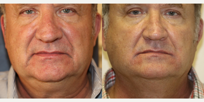 55-64 year old man treated with Injectable Fillers - This gentleman had 2 cc Restylane injected into his Marionette lines.