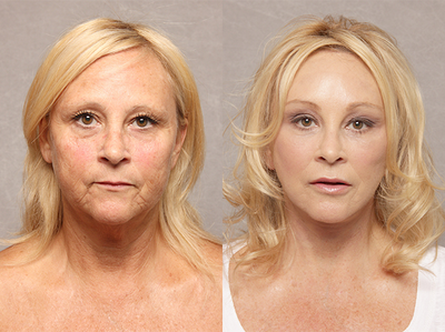 Fat Transfer - 55 years old, 3 months post-op, Refresher Facelift w/Neck Plication & Defatting, Dual Plane Browlift, Fat Injections to Cheek & Cheekbone Area & Lips, Intra-Conunctival Lower Lid Blepharoplasty (Removal of Fat Pads Lower Lids) and TCA Peel Peri-orbital (Eye Area)