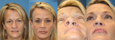 Revision Rhinoplasty -
Cleft palate nasal repair to improve nasal asymmetry.