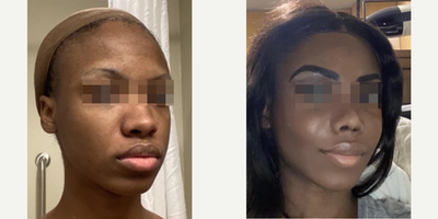 Woman treated with Cheek Augmentation - Woman treated with Cheek Augmentation