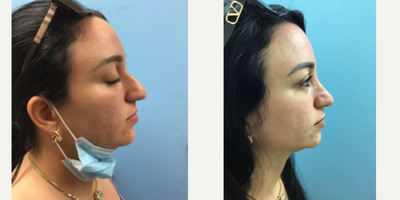 25-34 year old woman treated with Rhinoplasty - 25-34 year old woman treated with Rhinoplasty