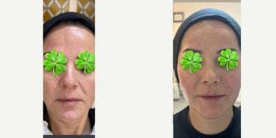35-44 year old woman treated with Nonsurgical Facelift - Due to fast weight loss, the patient had a volume loss. The treatment is obtained is liquid face lift.