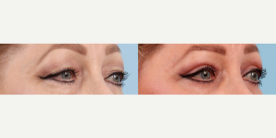 45-54 year old woman treated with Eyelid Surgery - Upper Blepharoplasty before and after, oblique right